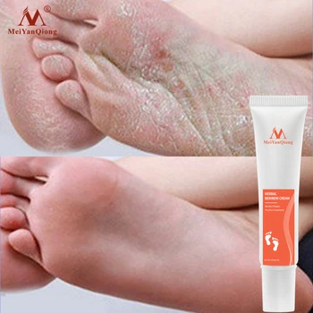 Picior de Îngrijire Crema de Picioare Pedichiura spa de Detoxifiere pe bază de Plante Anti Infectie Onicomicoza Ciuperca Tratament Pentru picioare Elimina Mirosul de Picioare Crăpate