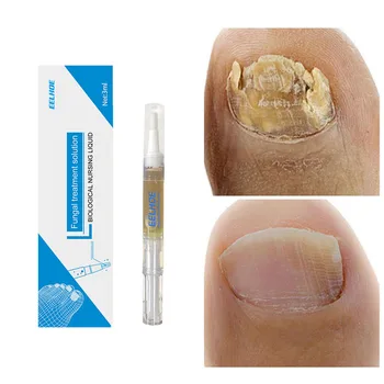 Tratament Ciuperca Unghiilor Ser Pen Anti Fungice Infecție Paronichie Onicomicoza Unghiilor Deget De La Picior Lichid De Îndepărtare Gel Exfoliant Picior De Îngrijire